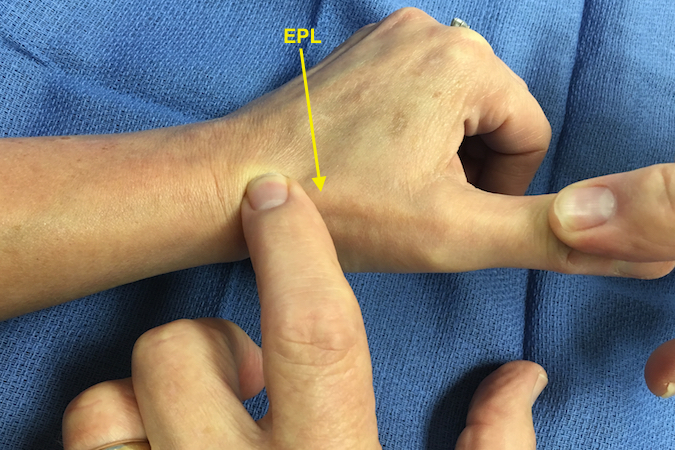 Extensor Tendon Exam Hand Surgery Resource 4002
